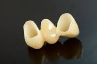 Tandlabo de Wilde Freddy voor al uw kronen, bruggen of implantaten